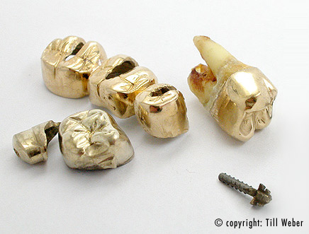 436x331-beisp-zahngold_a.jpg